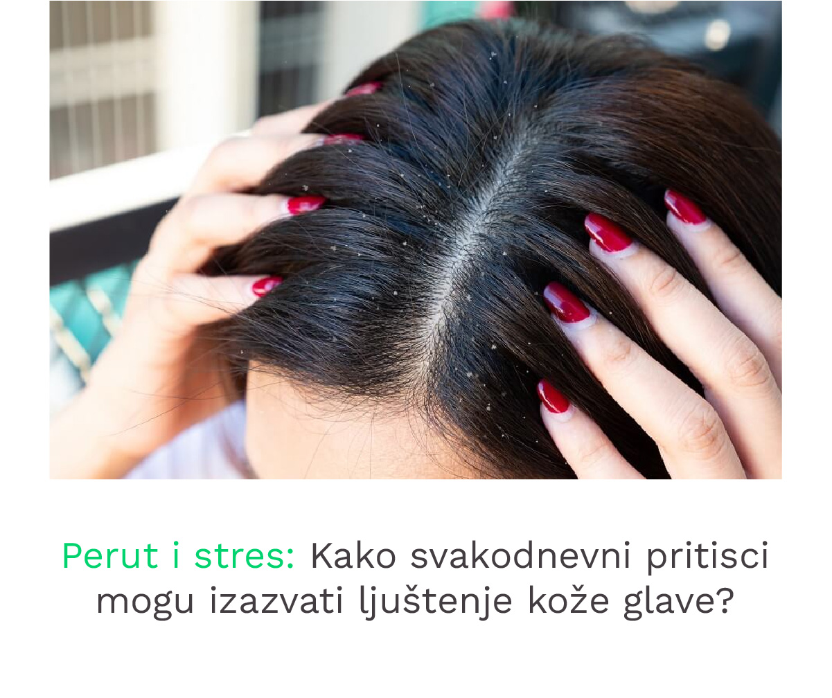 Perut i stres kako svakodnevni pritisci mogu izazvati ljustenje koze glave